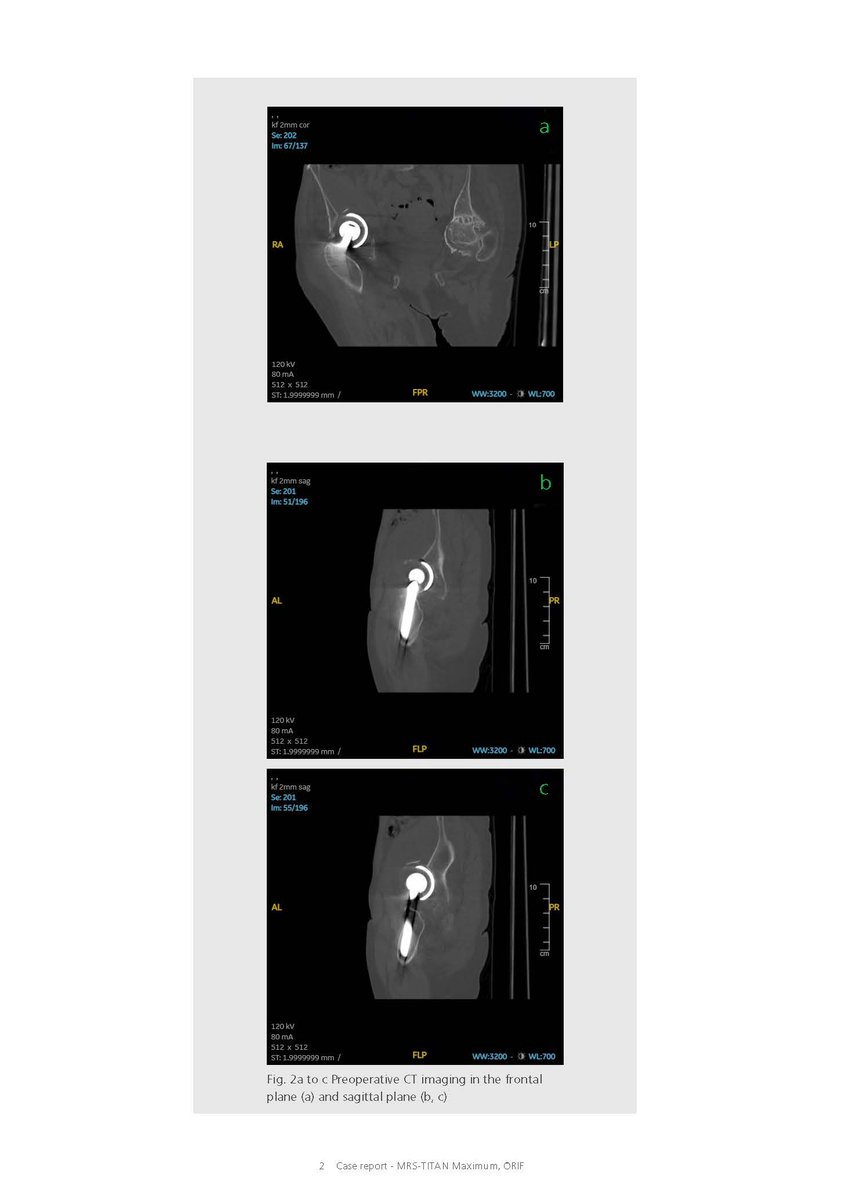 PETERBREHM_GmbH's tweet photo. Reliable treatment of a geriatric acetabular fracture with proven revision cup MRS-TITAN Maximum and additional ORIF. Early load-stable postoperative mobilisation of the patient. Request more case reports: marketing@peter-brehm.de #PETERBREHM #orthopaedics #orthopedics #revision https://t.co/T9LxhMeQfS