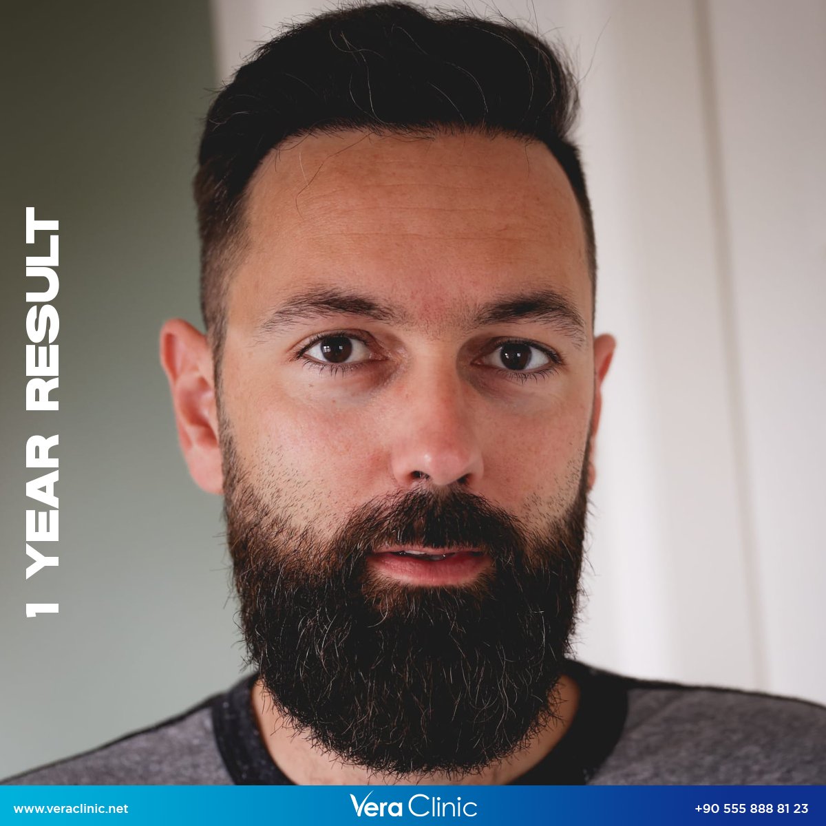 Witness the remarkable results of a hair transplant journey, showcasing before and after photos taken just one year apart.📸 Get a free consultation: 📲 +90 555 888 81 23 👉veraclinic.net #hairtransplant #hairtransplantturkey