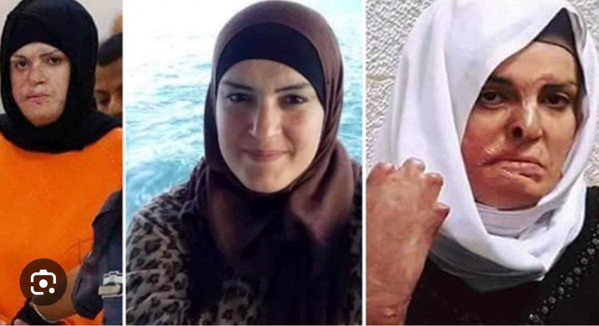 QudsNen's tweet photo. Israa  Al-Ja'abees, a mother of one child, was one day buying household items in a city when occupying soldiers opened fire on her, causing her car to catch fire. The soldiers left Israa burning without offering assistance or allowing anyone to rescue her. However, they later arrested her after she sustained burns covering 50% of her body. She is supposed to be among the #Palestinian hostages to be released in the first batch of the exchange deal between the #Palestinian resistance and the occupation state.