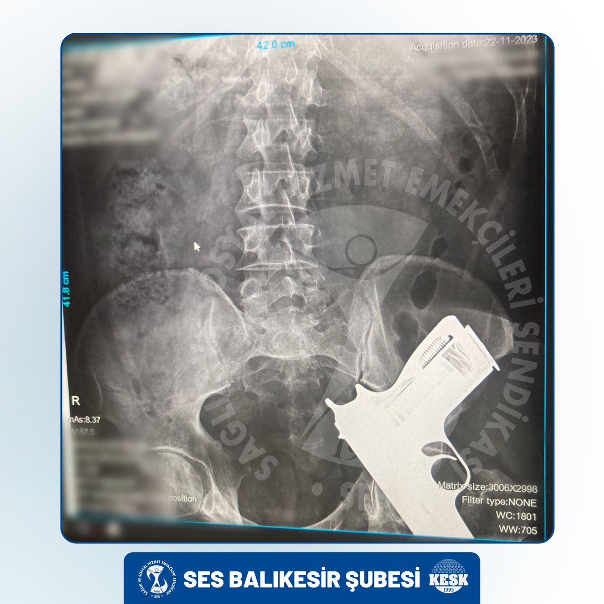 Biraz önce bir radyoloji teknikeri üyemizin bize ulaştırdığı bu röntgen filmine iyi bakın. Bu görsel hastanelerde her gün şiddete maruz kaldığımız, dayak yediğimiz, öldürüldüğümüz, hakarete uğradığımız gerçeğinin en net görünümüdür. En küçük bir tartışmada bu silahın belden