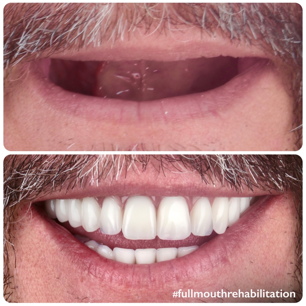 doctor_michaels's tweet image. #SmileTransformed!

Take this patient's case, for instance.

Thanks to Dr. Amir Hadjhamou's skilled treatment using an all-on-4 implant-supported fixed prosthesis, this patient gained not just a full set of teeth but a dazzling smile.