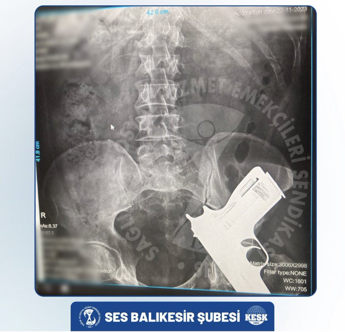 eacarerX's tweet photo. Balıkesir’de bir röntgen filmi: 
Ancak Türkiye’de olur: 
Sağlıkta şiddet ve silahlanmanın röntgeni de çıkmış! https://t.co/16NRSL3uhR