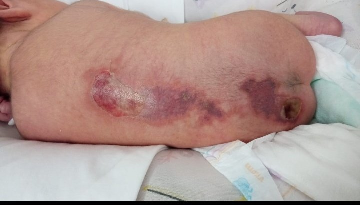 Necesito difusión para salvar vida. 
Hospital de Villaguay. 
Nace una beba y la queman con una bolsa de agua caliente. 
El personal engañan a los padres con que era un hematoma.
La beba se encuentra internada en el hospital San Roque de Paraná. 
El hospital de Villaguay ya hubo