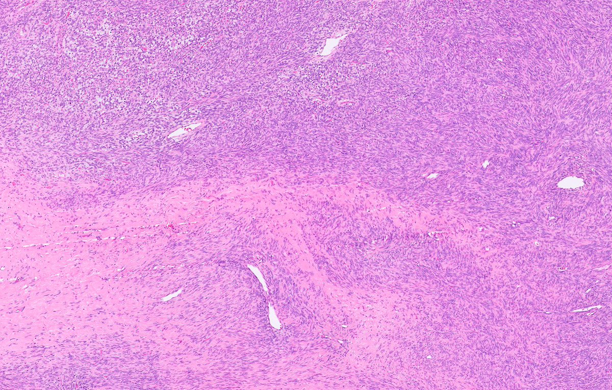 katcollmd's tweet photo. #slidearchiveseries solitary fibrous tumor of prostate #gupath #BSTpath #pathtwitter #pathoutpic

🔬haphazardly arranged ovoid and spindle cells with indistinct cell borders, variably collagenous stroma, hemangiopericytoma-like blood vessels
🎨 STAT6 and/or CD34 https://t.co/bG8LbwmKSE