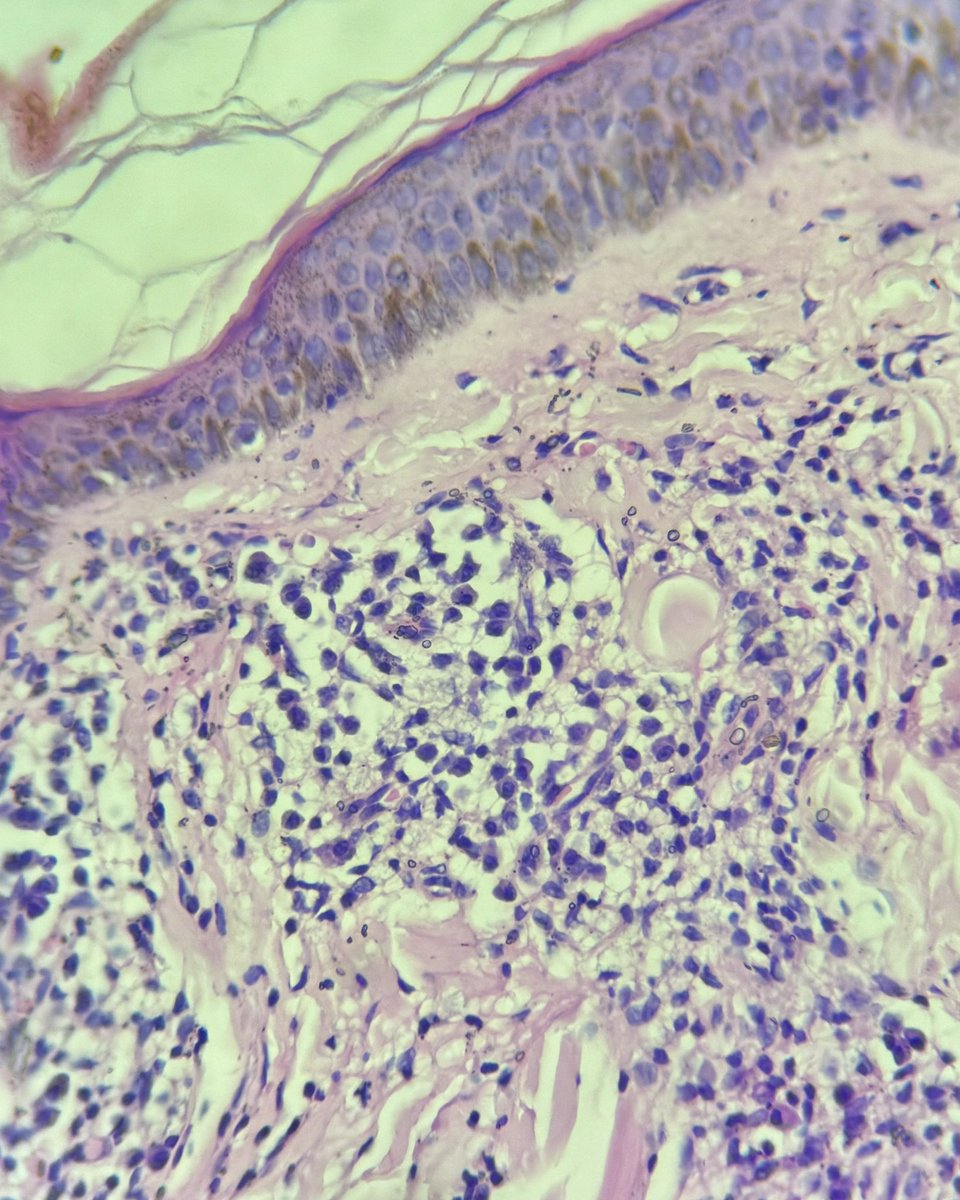 megha_lalcheta's tweet photo. Lepramatous leprosy case #fitefaracco #pathology #bacilli
Thinned out epidermis
Clear grenz zone
Perivascular and perineural lymphoplasmacytic infiltrate along with foamy cells
#pathology #dermapath #pathresidents #biopsy #PathTwitter https://t.co/PhhllAuBfg