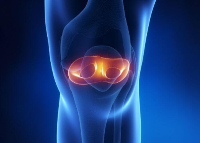 What are the different methods of treating a #meniscustear? -Partial Meniscectomy -Meniscus Repair: outside-in -Meniscus Repair: inside-out -Meniscus Repair: all-inside -Meniscus Transplantation Learn more>>>medilink.us/o8p4 #meniscus #kneesurgery #orthotwitter