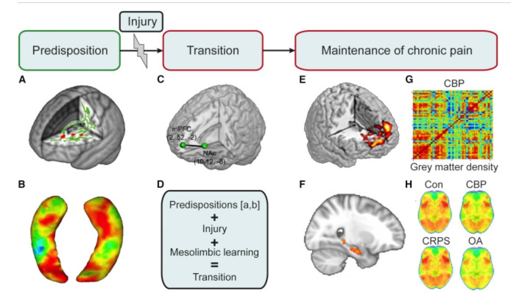 This makes sense 🫵 4 phases of transition from #acute to #ChronicPain In this paper (published in the prestigious journal @NeuroCellPress), the #brain circuitry and their interactions across the phases are illustrated in human brain imaging studies. Check this thread 👇1/9