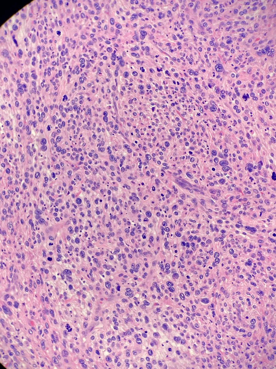 kaseyjeanene's tweet photo. Great example of high-grade myxofibrosarcoma of the leg! Grade 3. Not treated. Lovely low power impression of lower grade areas transitions to high grade! https://t.co/ceUGW75wvN