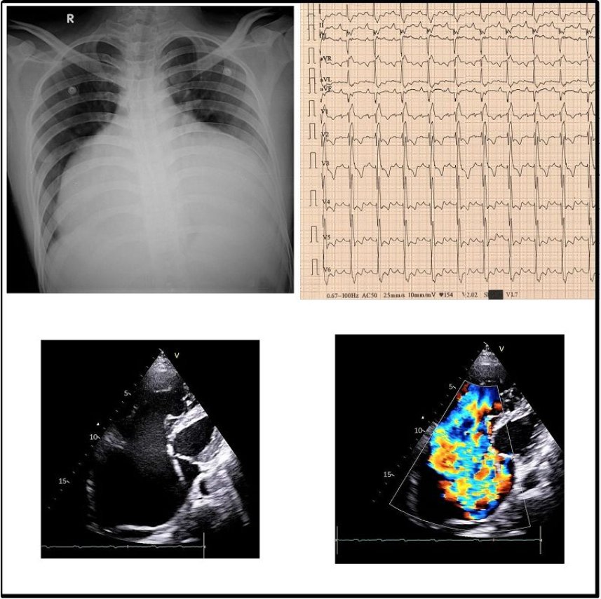 #ImageoftheWeek : @ESC_Journals
A teenage boy presented with worsening shortness of breath and palpitations over the last six months. CXR and ECG are followed by 2D echocardiogram. What is the diagnosis?
👇👇👇👇👇
☑️bit.ly/3RdUZoA
#CardioEd #CardioTwitter #cardiology