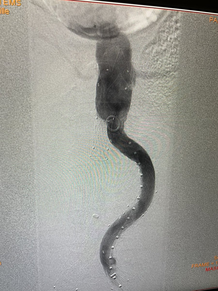 @farkomd Wow! I had a similar case recently with Endurant graft failure 
Patient presented with rupture from contra gate
Relined with Gore 
Patient was lost to follow up and we assume a bad acting endoleak / aneurysm degen
#AortaEd #VIR #MedTwitter #VascSurgery #Teamwork