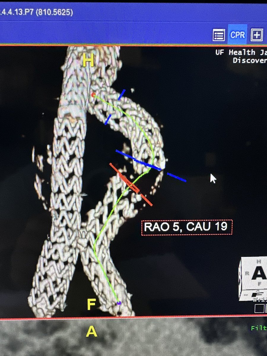 DoctorCliffyy's tweet photo. @farkomd Wow! I had a similar case recently with Endurant graft failure 
Patient presented with rupture from contra gate
Relined with Gore 
Patient was lost to follow up and we assume a bad acting endoleak / aneurysm degen
#AortaEd #VIR #MedTwitter #VascSurgery #Teamwork https://t.co/itHAj1UuN1