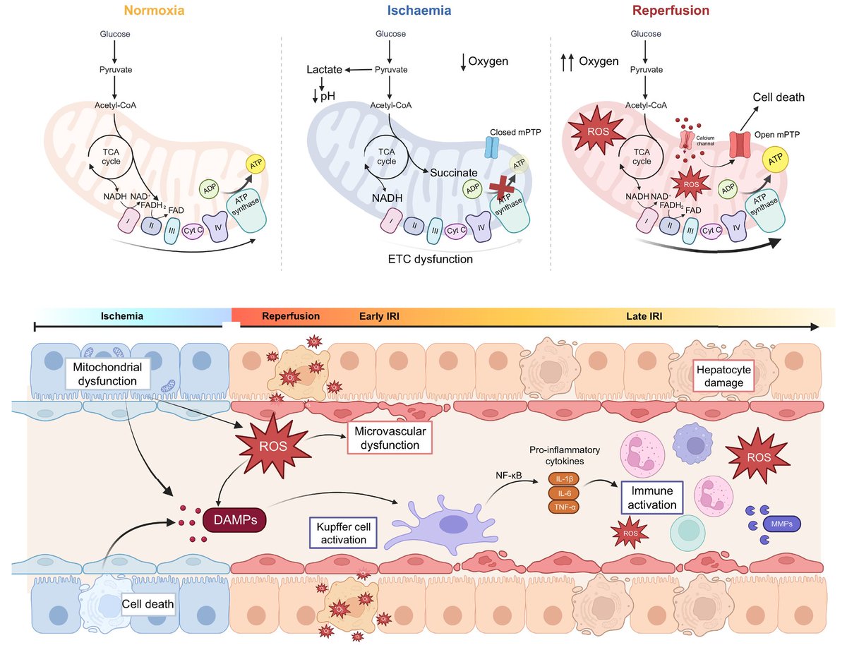 The role of ischaemia-reperfusion injury and liver regeneration in hepatic tumour recurrence 🔓#OpenAccess at 👉 jhep-reports.eu/article/S2589-… #LiverTwitter