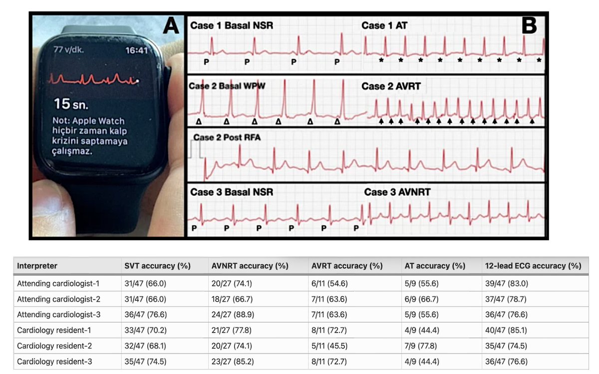 JICE (@jice_ep) on Twitter photo 🚨Latest #FreeRead Article in <a href="/JICE_EP/">JICE</a>
Diagnostic Accuracy of Apple Watch Series 6 Single-lead ECGs for Identifying SVT: Comparative Analysis w/ Invasive EP Study
by <a href="/YalinKivanc/">Kıvanç YALIN</a> <a href="/aliugursoysal/">Ali Uğur Soysal</a> <a href="/hasantokdilmd/">Hasan Tokdil, MD 🫀</a> M Cimci, H Karpuz & Colleagues
📖🧐rdcu.be/drLdH
#EPeeps 🚨Latest #FreeRead Article in <a href="/JICE_EP/">JICE</a>
Diagnostic Accuracy of Apple Watch Series 6 Single-lead ECGs for Identifying SVT: Comparative Analysis w/ Invasive EP Study
by <a href="/YalinKivanc/">Kıvanç YALIN</a> <a href="/aliugursoysal/">Ali Uğur Soysal</a> <a href="/hasantokdilmd/">Hasan Tokdil, MD 🫀</a> M Cimci, H Karpuz & Colleagues
📖🧐rdcu.be/drLdH
#EPeeps