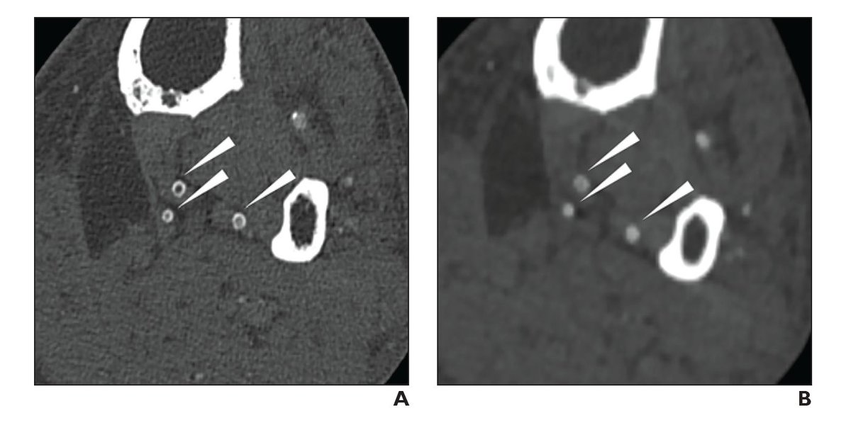 Use of photon-counting detector CTA may improve vascular evaluation in patients with peripheral arterial disease. ajronline.org/doi/10.2214/AJ…