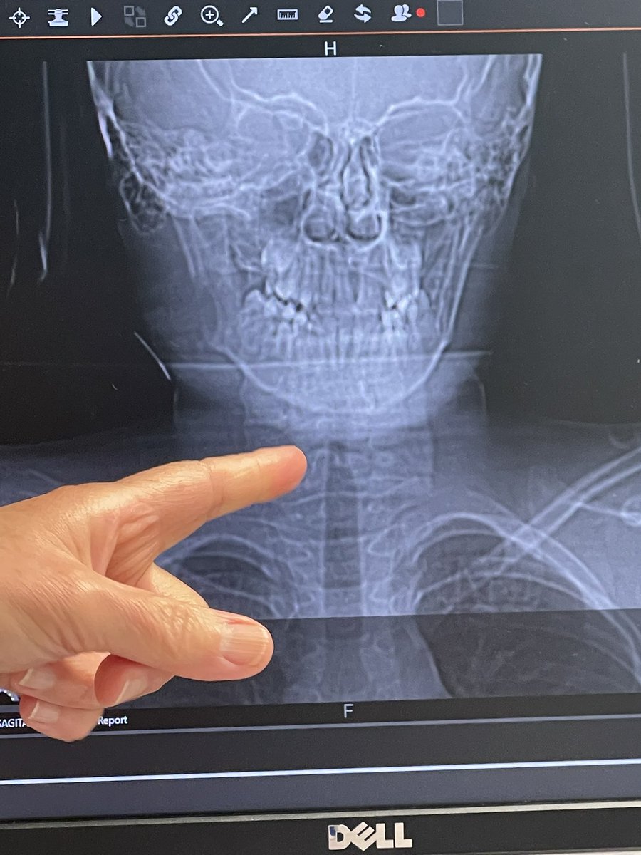 TheHauntedSiren's tweet photo. My 11year old nephew has been diagnosed with Langerhans Cell Histiocytosis. It is in his Jaw bone and it made a hole and there’s necrotic tissue all around the hole. We are looking for other people who have gone through this in the jaw.  🎗️ #cancer https://t.co/8cE7gYT0sv