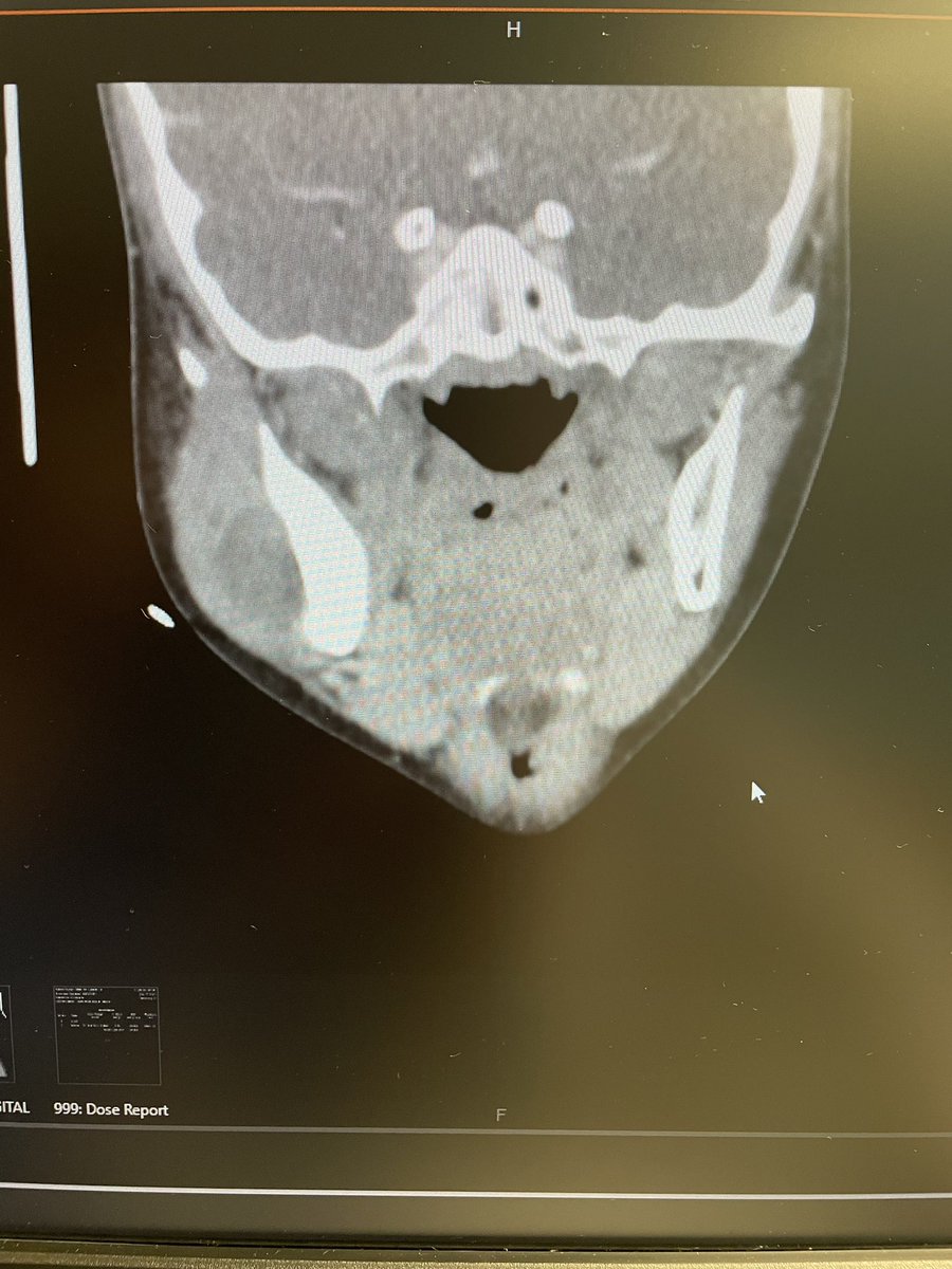 TheHauntedSiren's tweet photo. My 11year old nephew has been diagnosed with Langerhans Cell Histiocytosis. It is in his Jaw bone and it made a hole and there’s necrotic tissue all around the hole. We are looking for other people who have gone through this in the jaw.  🎗️ #cancer https://t.co/8cE7gYT0sv
