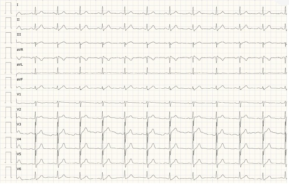 gabims85's tweet photo. Importancia de las derivaciones precordiales altas en pacientes en estudio por sospecha de Sde de Brugada
1er ECG con derivaciones habituales
2° ECG mismo paciente con derivaciones precordiales altas (V1-V2 segundo espacio, V3-4 tercer espacio, V5-V6 cuarto espacio intercostal) https://t.co/yotK54HaVO