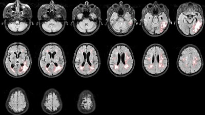 @HoebelKathi @ca_chung @kencchang @kalpathy1 study experts' ratings of brain tumor segmentation doi.org/10.1148/ryai.2… @qtimlab @MGHMartinos #DeepLearning #AI #ML