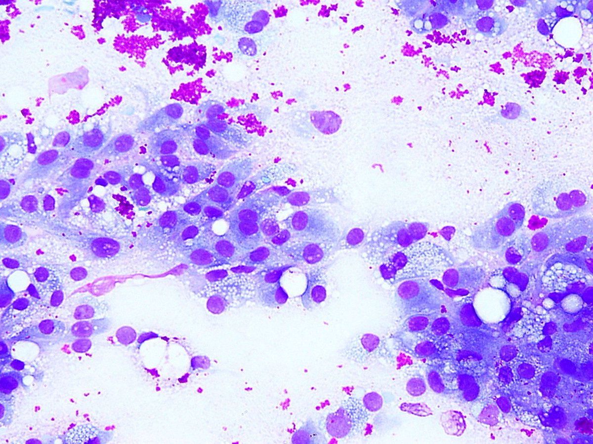Alaa_Hrizat's tweet photo. Secretory carcinoma of parotid with the characteristic histiocyte-like cells. 

#cytology #cytopath https://t.co/01GUvKpyTx