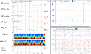 Erklauer et al: The State of the Field of Pediatric Multimodality Neuromonitoring Link: ow.ly/RxXh50Q8qtl @neurocritical #NeuroCritCare
