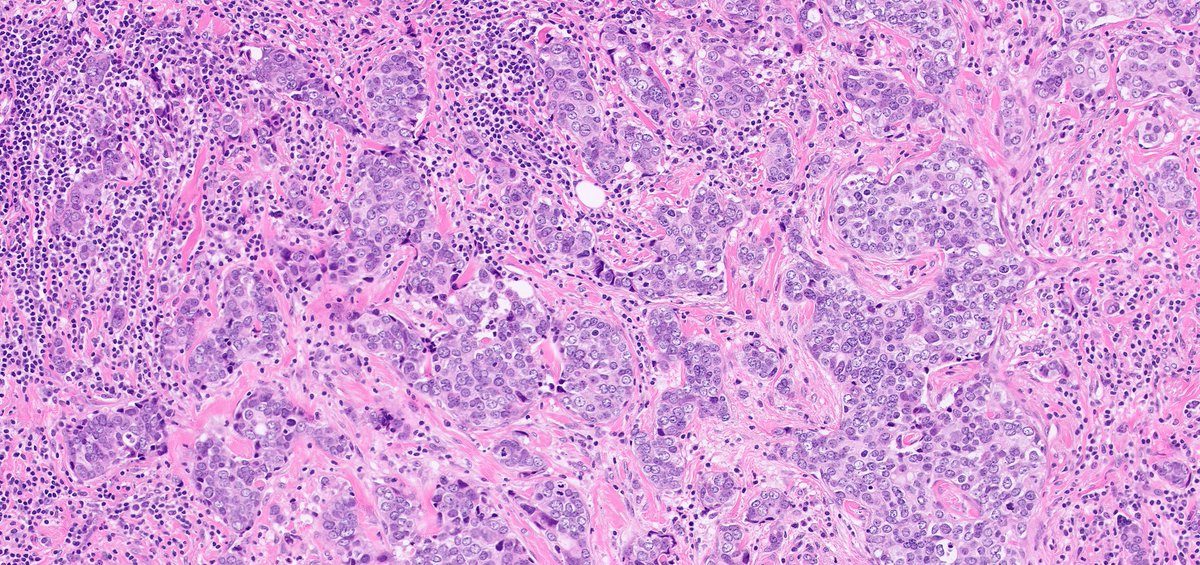 1/Can a HER2-negative cancer ”change” into a HER2-positive within weeks???
Technically speaking yes, as exemplified by this example. 😁
The explanation is intratumoral HER2 heterogenicity coupled with sampling issues. 👇👇