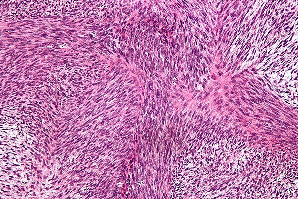 47 y/o F

Circumscribed, unencapsulated mass of the deep R thigh

+Ki67, Reticulin
- S100, keratin H3K27me3 

Dx?

#pathagonia #softtissue #ortho #surgx #hemeonc #mskx #orthopedics #pathx