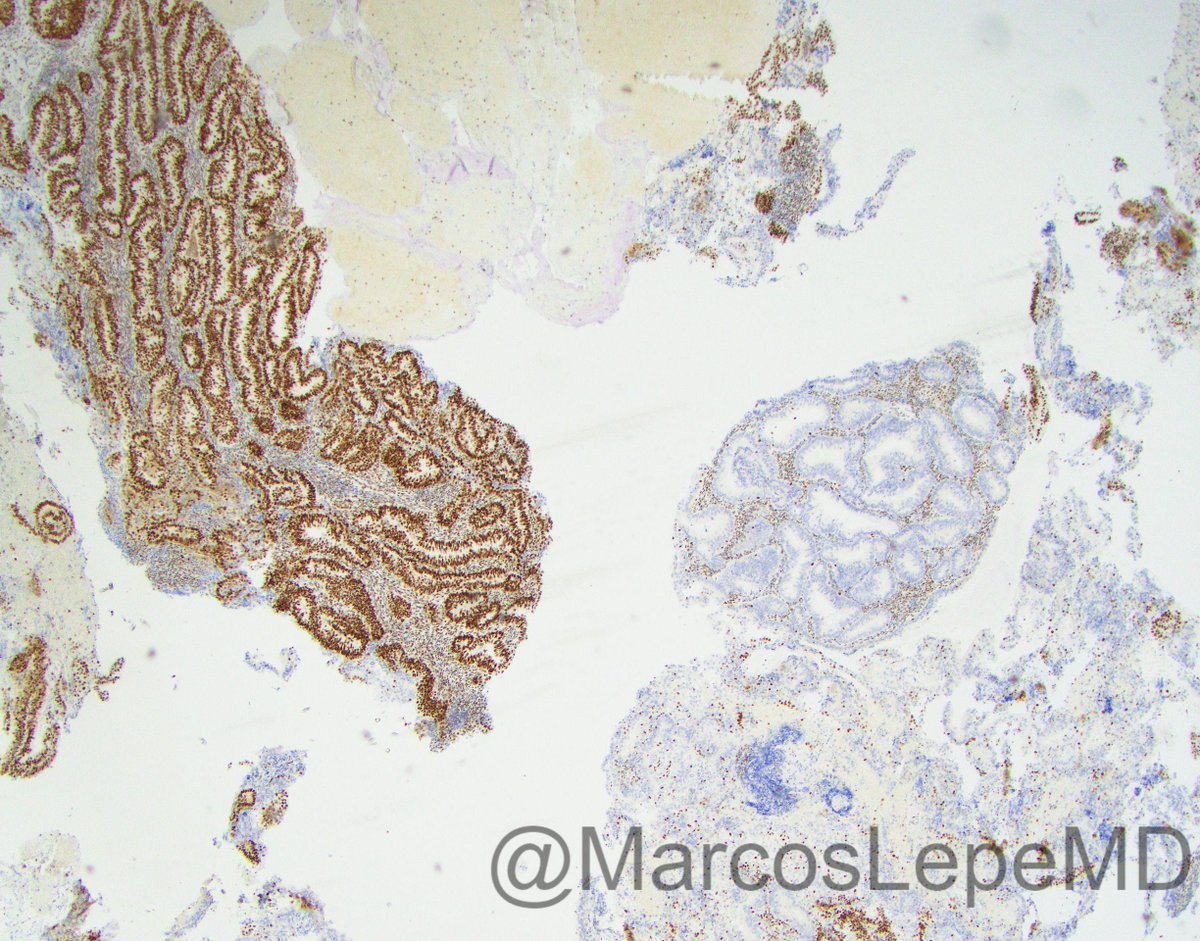 😶‍🌫️Read-my-mind sort of post

What is this? and what is it showing?

The hint is in the hashtags

#GynPath #gynecologicpathology