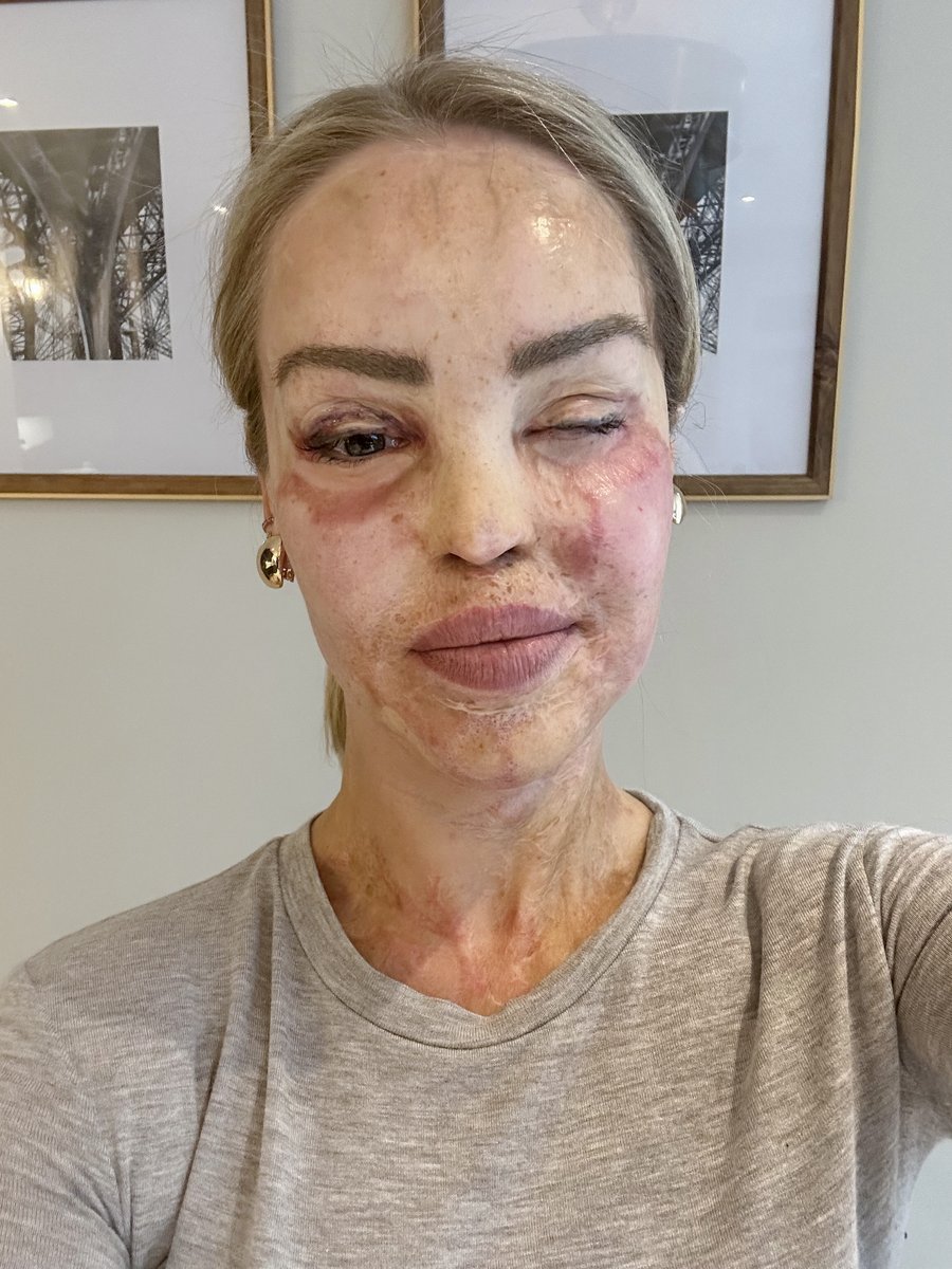 This is me! (For now) On Tuesday I had a planned operation ...