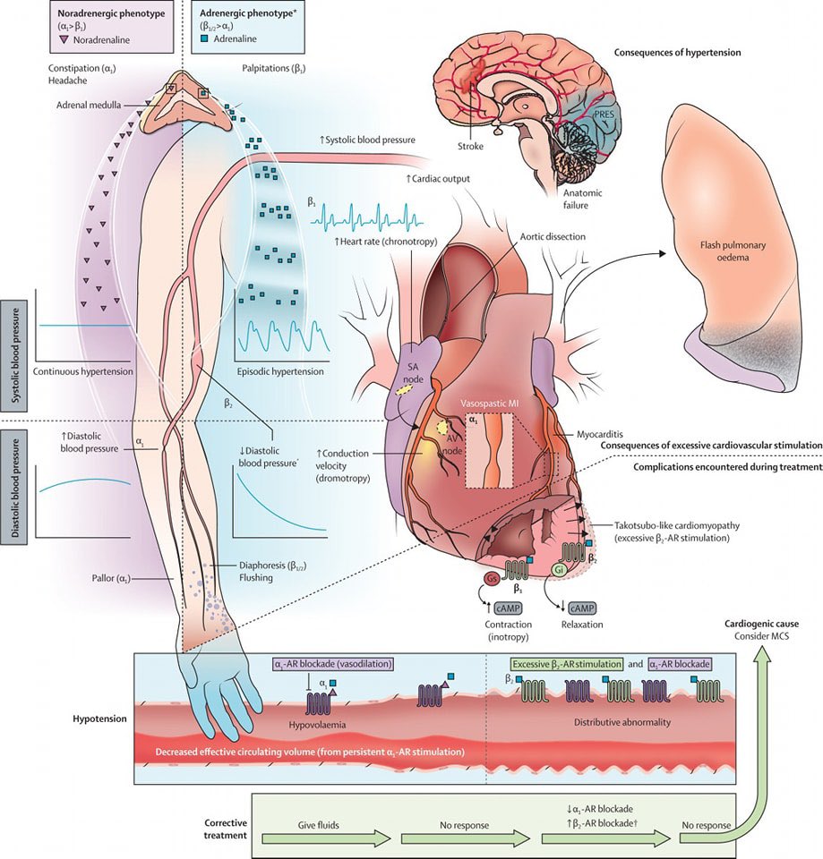 Ed_Alania's tweet photo. 🟢 Catecholamine-induced hypertensive crises: current insights &amp; management @TheLancetEndo #Cardioed #Cardiology #ENARM https://t.co/Yy0ZlWTwkw