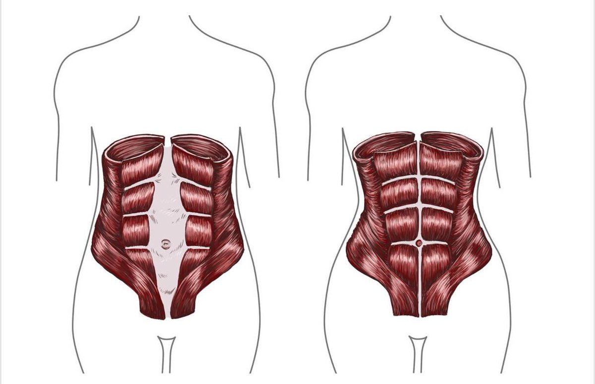 🚨طريقة إغلاق الانفصال العضلي 🚨
#ثريد 
فضلها وأكيد بترجع لها لو مرت عليك هالحاله او احد قريب منك تحس انه يعاني بسببها♥️