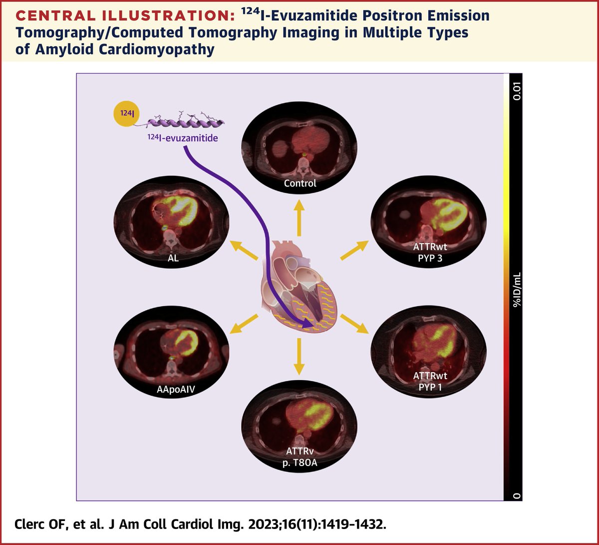 124I-evuzamitide PET/CT accurately identifies cardiac light chain & TTR #amyloidosis, excludes amyloid in healthy controls, & may be better than 18F-florbetapir for TTR quantification. bit.ly/46bb7LN #ThinkPET #cvPET #JACCIMG @SVijayakumarMD @DorbalaSharmila