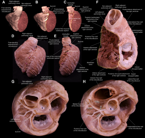 Comprehensive anatomy of the Summit of the left ventricle. Another outstanding paper by <a href="/shivkumarmd/">Kalyanam Shivkumar MD PhD</a> for all cardiac anatomy enthusiasts.
A must for those doing #VTAblation 

👉 bit.ly/LVSMT

<a href="/JACCJournals/">JACC Journals</a> #Epeeps #FOAMed #cardioTwitter