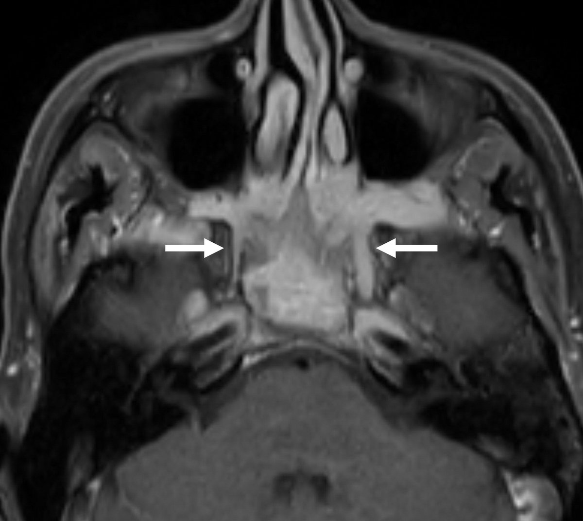 RadioGraphics's tweet photo. Although the PPF is a very complex anatomic space, this writeup helps simply this space and how it communicates with other important spaces in the neck especially in regards to head and neck pathologies. https://t.co/NgnWCY7kmA @albasalpar @abelghuete https://t.co/pNm2OxBqKz