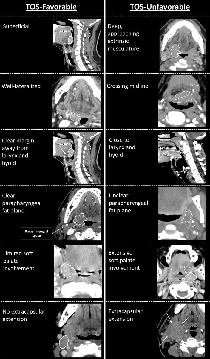 @piet_ost @msaerens01 There's a big difference between T1/T2 tumors that are amenable to surgery and those that aren't (below). Can't be fixed with propensity matching. That's why the RT group does worse in these comparisons. 5-year results from ORATOR & primary analysis of ORATOR2 coming soon.