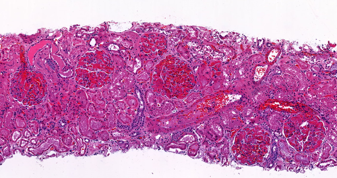 roboonya's tweet photo. Preimplantation biopsy with 100% fibrin thrombi from donor with DIC. Although considered not suitable for transplantation, decent graft outcome can be achieved. May be reasonable choice for older recipients with co-morbidity #renalpath #transplantpath https://t.co/vrQVANPbop