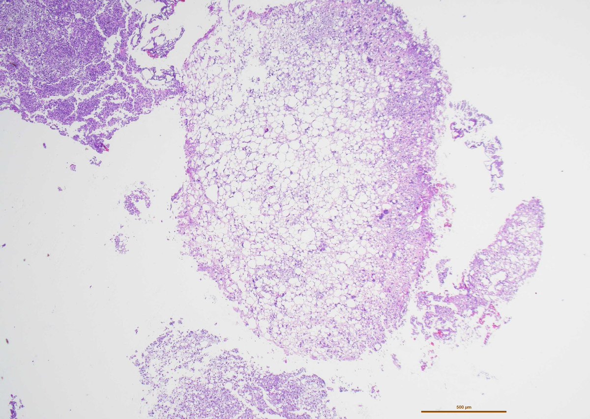 Andres_Matoso's tweet photo. Lipoid subtype of urothelial carcinoma can truly mimic a well dif liposarc. Adding to the confusion is the frequent MDM2 amplification that can be seen in both. Key is to identify conventional UCa. Not uncommonly, the lipoid component loses keratin expression. #gupath https://t.co/rTmB2aXuJ5
