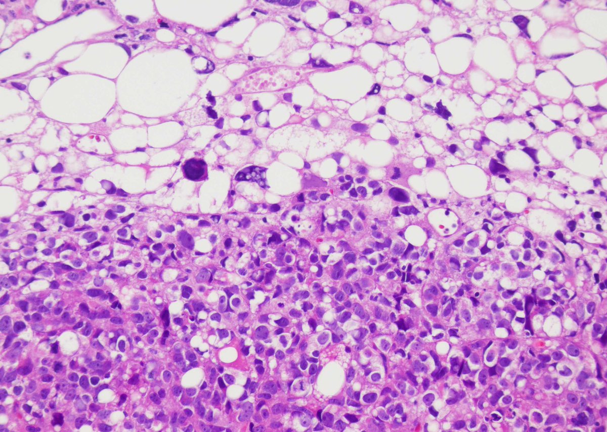 Lipoid subtype of urothelial carcinoma can truly mimic a well dif liposarc. Adding to the confusion is the frequent MDM2 amplification that can be seen in both. Key is to identify conventional UCa. Not uncommonly, the lipoid component loses keratin expression. #gupath