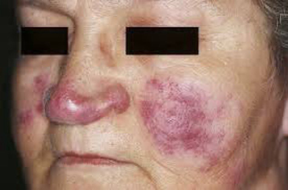 A patient with history of iritis presented with a slowly, progressively worsening rash on her face for 8 years. Skin biopsy showed noncaseating granulomas. What is the likely diagnosis? (Image Wikipedia) #medX