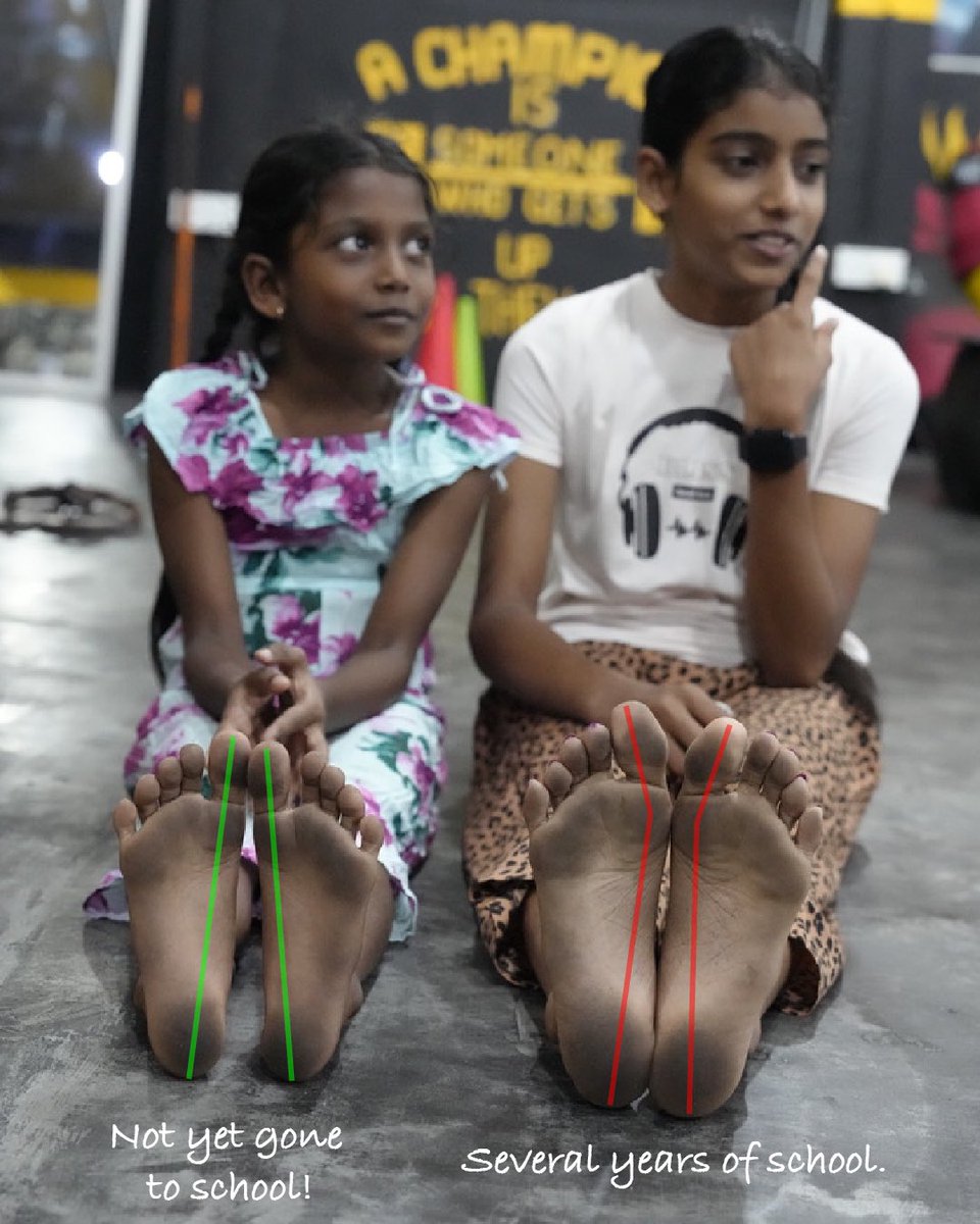 MyFootFunction's tweet image. Do genetics play a role?
Two sisters:
Younger sister has yet to go to school & therefore never worn shoes.
The older sister has been wearing tightly fitted shoes for 2+ years.