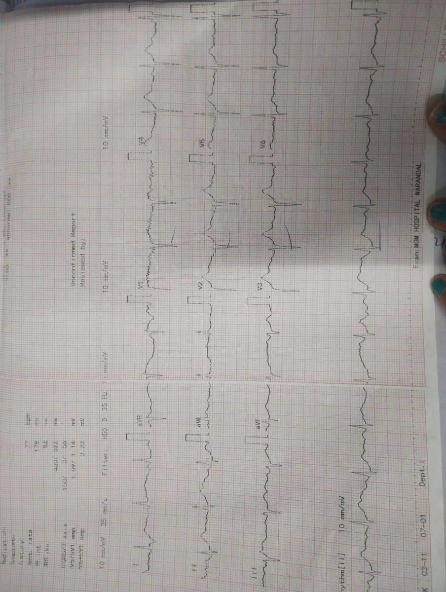 Chrysa43710835's tweet photo. Posting ECG of the same man https://t.co/FeWpWvmkak