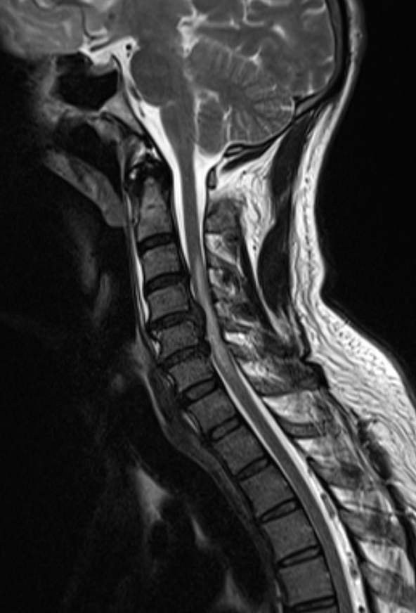 Compressive myelopathy due to multiple cervical disc extrusion and subligament migration #foamed #foamrad @elearnrad #elearnrad #drbabu #rad #radres #medtwitter #kuwait