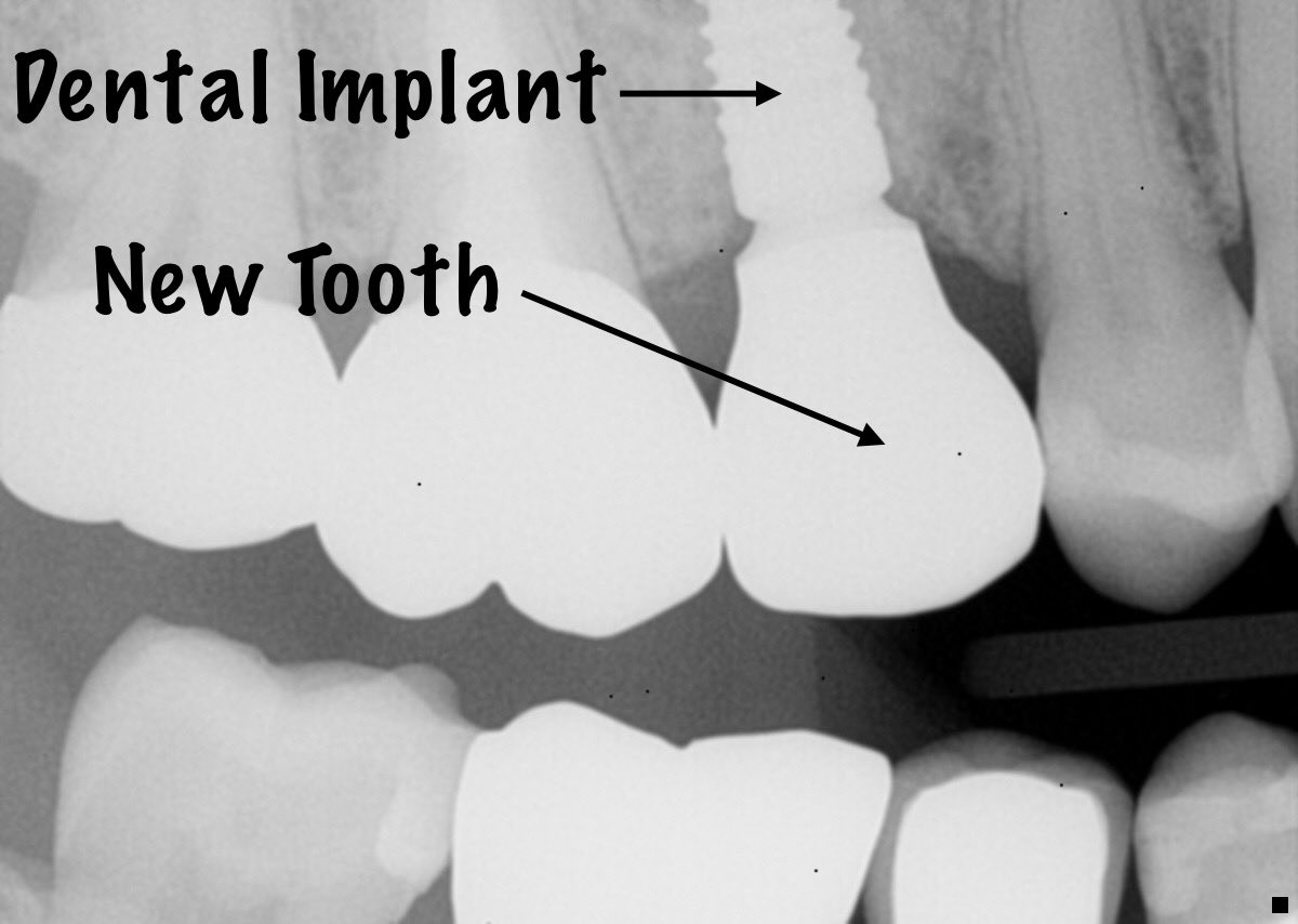 FrandsenDDS's tweet photo. Implant cases.  The best way to replace a missing tooth is with a dental implant.  If you are missing a tooth or teeth, let us show you how a dental implant can easily and effectively get you a new tooth.  #IdahoFallsSmiles #dentalimplants #implantdentistry #straumann https://t.co/fyJdC8uTbs