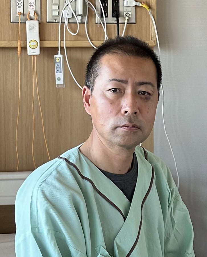 shogen_m's tweet photo. まさかとは思いましたが、顔の痺れが引かないため病院にかかったところ、頬骨が骨折していることが分かり、明日24日に手術をすることになりました。
早く回復し、公務に復帰できるなよう努めますので、ご理解をお願いいたします。
#高森町 #南信州 #頬骨骨折 #飯田市立病院 #ヒートショック #高血圧 https://t.co/NNyVrHBvIg