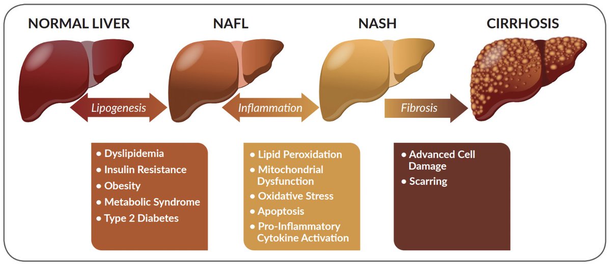 ClausCarlsen1's tweet photo. Fructose and seed oils are two dietary factors that have been linked to inflammation.

Fructose is found in fruits, honey, and processed foods. When fructose is consumed, it is metabolised in the liver. 
This process can lead to the production of inflammatory compounds, such as C-reactive protein (CRP) and interleukin-6 (IL-6).

Seed oils are oils that are extracted from the seeds of plants, such as sunflower, corn, soybean, and canola. 
Seed oils are high in omega-6 fatty acids. Omega-6 fatty acids are essential fatty acids, but consuming too many omega-6 fatty acids can lead to inflammation.

The ratio of omega-6 to omega-3 fatty acids is a crucial aspect of dietary fats. Ideally, this ratio should be low, as a high ratio of omega-6 to omega-3 fatty acids is linked to inflammation and chronic diseases. Standard diets according to dietary guidelines often had ratios of around 1:1 to 3:1, but many modern diets can have ratios as high as 15:1 to 17:1, heavily favouring omega-6s.

Inflammatory effects of fructose and seed oils
Fructose and seed oils have been linked to several inflammatory diseases, including:
- Arthritis
- Obesity
- Fatty liver disease
- Pancreatitis
- Type 2 diabetes
- Heart disease
- Stroke
- Alzheimer's disease
- Cancer
- etc.

To reduce inflammation caused by fructose and seed oils, it is important to:
1) Eliminate the intake of sugar, processed foods, and sugary drinks.
2) Choose meat, low starch vegetables, and berries over fruit and high starch vegetables.
3) Choose healthy fats, such as olive oil, avocado oil, butter, lard, tallow, and coconut oil, over seed oils.
4) Eat a whole, unprocessed foods.
5) If you are concerned about inflammation, talk to your ”low carb no-seed-oils” doctor. They can help you assess your risk factors and recommend ways to reduce inflammation.

Here is a longer list of processed foods & drinks to avoid, as well as some fruits with a high fructose content and foods with a high Glycemic index
- Processed foods
- Sugar
- Sugary drinks, such as soda, juice, sweet tea, sports drinks, and energy drinks
- Alcoholic beverages
- Candy and chocolate
- Baked goods, such as any bread, pasta, cookies, donuts, cakes, and pastries
- Processed meats, such as hot dogs, sausage, and deli meats
- Frozen meals and pizzas
- French fries and other fried foods
- Instant foods, such as ramen noodles and macaroni and cheese
- Packaged snacks, such as chips, crackers, and pretzels
- Margarine and butter spreads
- Fruits with a high fructose content
- Dried fruits, such as raisins, dates, and apricots
- Bananas
- Grapes
- Apples
- Watermelon
- Pineapple

Foods with a high Glycemic Index
- Sugar
- Soda
- Rice
- Bread
- Pastries
- Candy
- Cornflakes, oats, other breakfast cereals
- Potatoes
- Oats
- Pasta
- Pizza

In simple terms: 
1) Eat meat, eggs, and some dairy and 
2) Keep almost all carbohydrates and alcohol out of your food & drinks choices.

Please comment!

Fructose consumption can lead to fatty liver and cirrhosis: