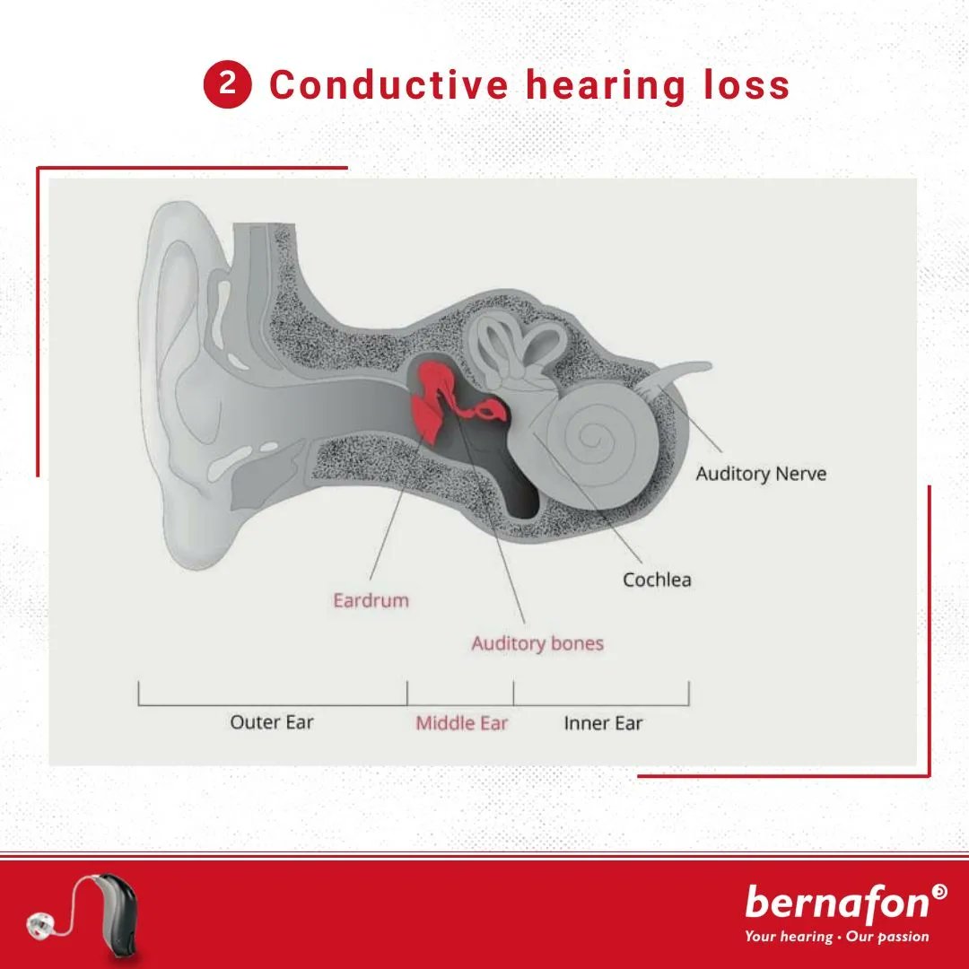 BernafonI's tweet photo. Understanding hearing loss is crucial for finding the right solutions. 

For personalized advice on Bernafon hearing aids, and to know more, call us at 7973410466.

..

..

#Bernafon #bernafoncares #bernafonleox #alpha #hearingloss #hearingimpaired #hear #HearTheMelody https://t.co/HS4iuV0Uua