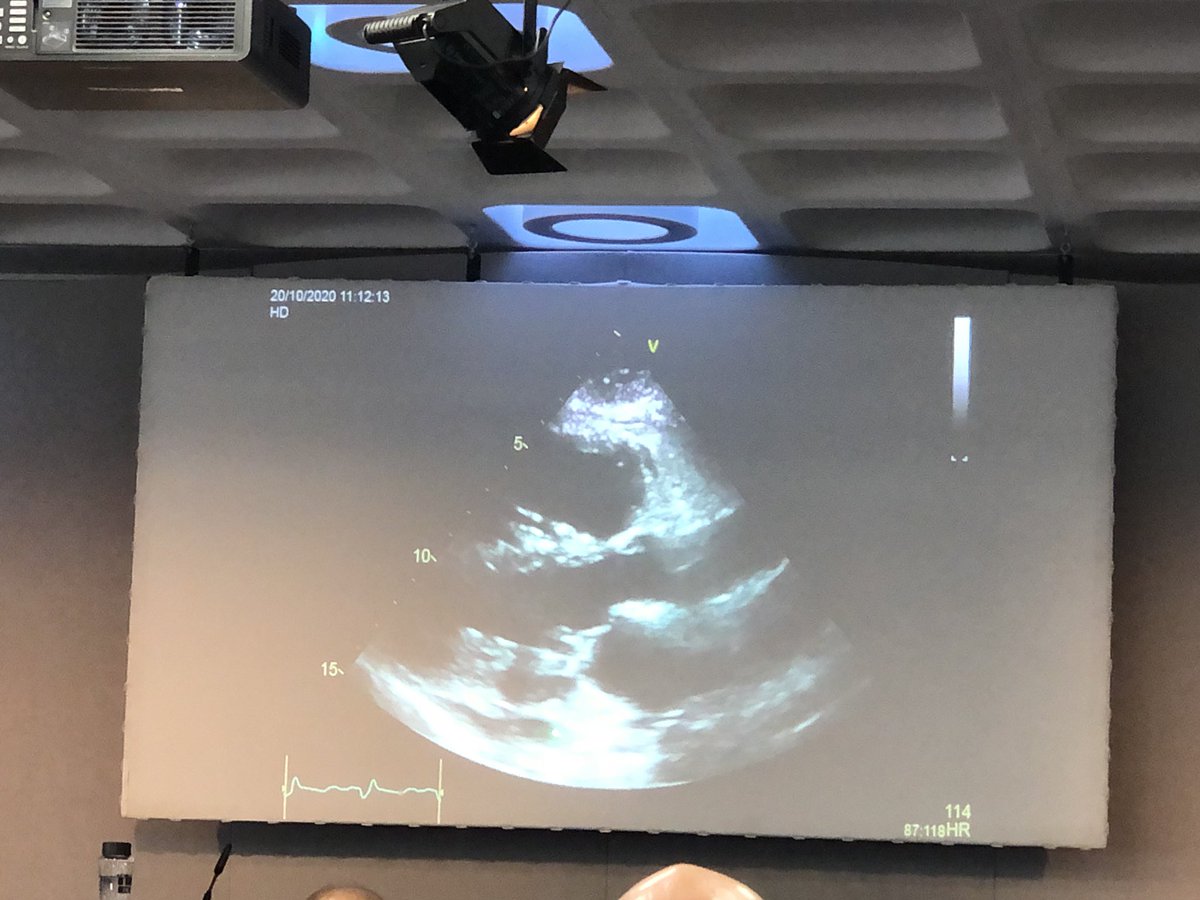 RebDCruz's tweet photo. @charlot_summers @msh_manu @johnglaffey @LaneFoxResearch Hugely educational session from @iceman_ex on established and emerging approaches to evaluating the right ventricle, no longer the forgotten ventricle!
Useful background reading on RV dysfunction in ARDS https://t.co/bbSzr60aiF
#BTSWinter2023 #BTSWinter #RespIsBest https://t.co/OkFhCsdMcR