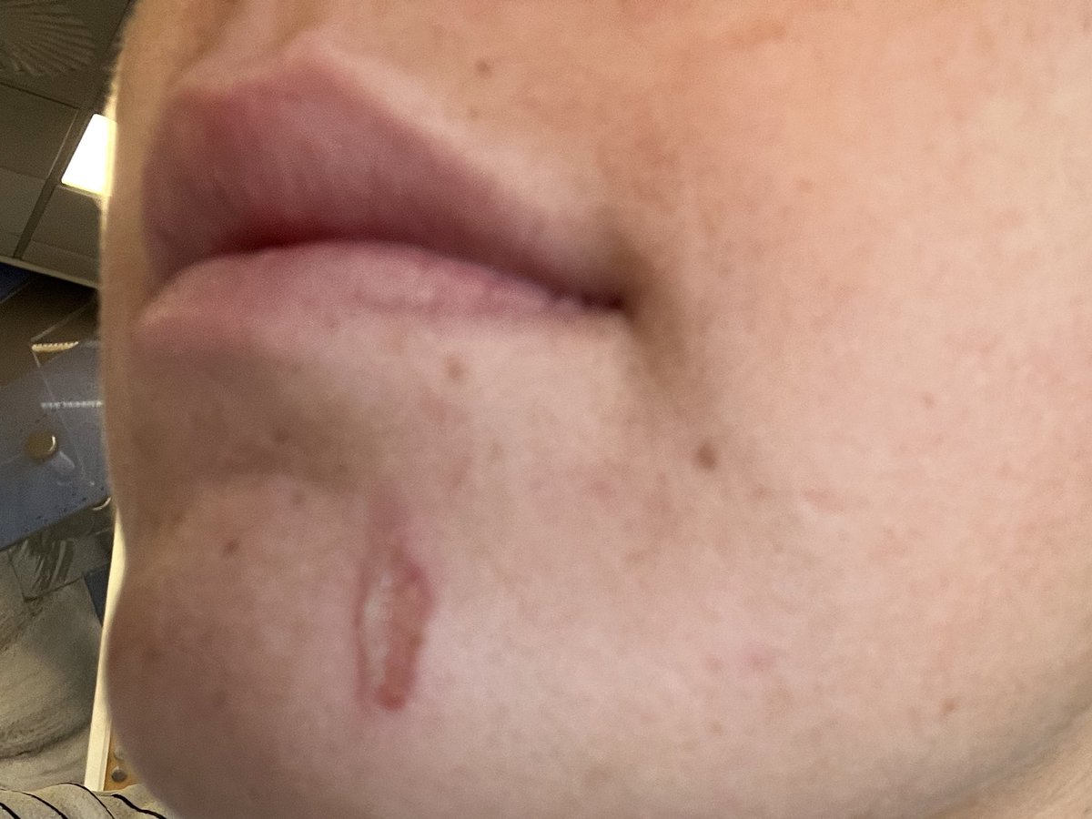 RebeccaJF__'s tweet photo. @McDonaldsUK @McDonalds would like to know how this is considered normal by your staff and treated as not severe when my face has a burn after ur pie has gone in me. I am 22 and know how to eat food by blowing it beforehand, but if this was in the hands of a child or worse. https://t.co/otpk9vR8OP