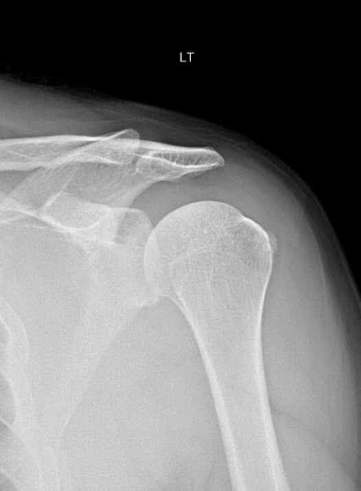 elearnrad's tweet photo. Calcific rotator cuff tendinopathy https://t.co/xuL7ib6mRR