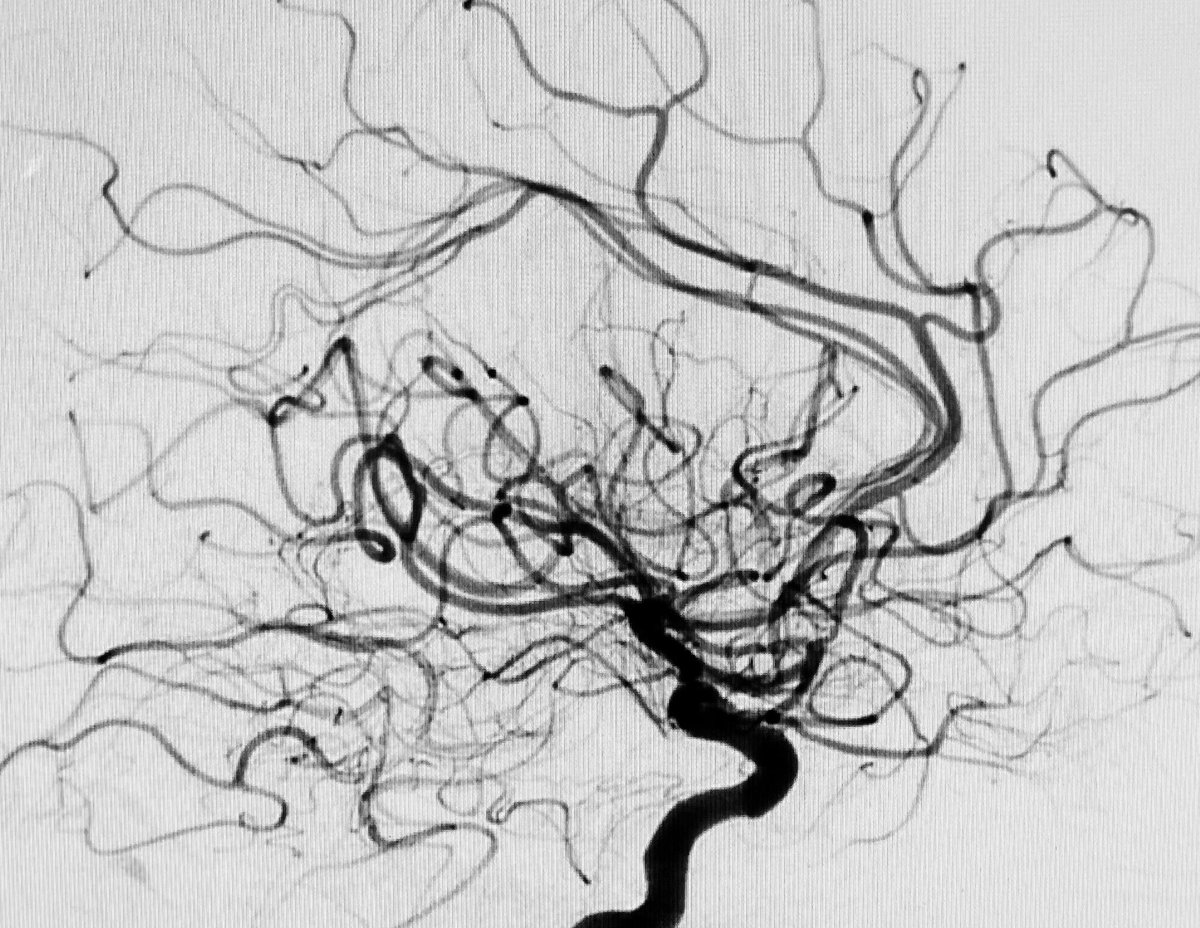 Symptomatic M1-M2 severe stenosis treated with #neurospeed and #credo stent