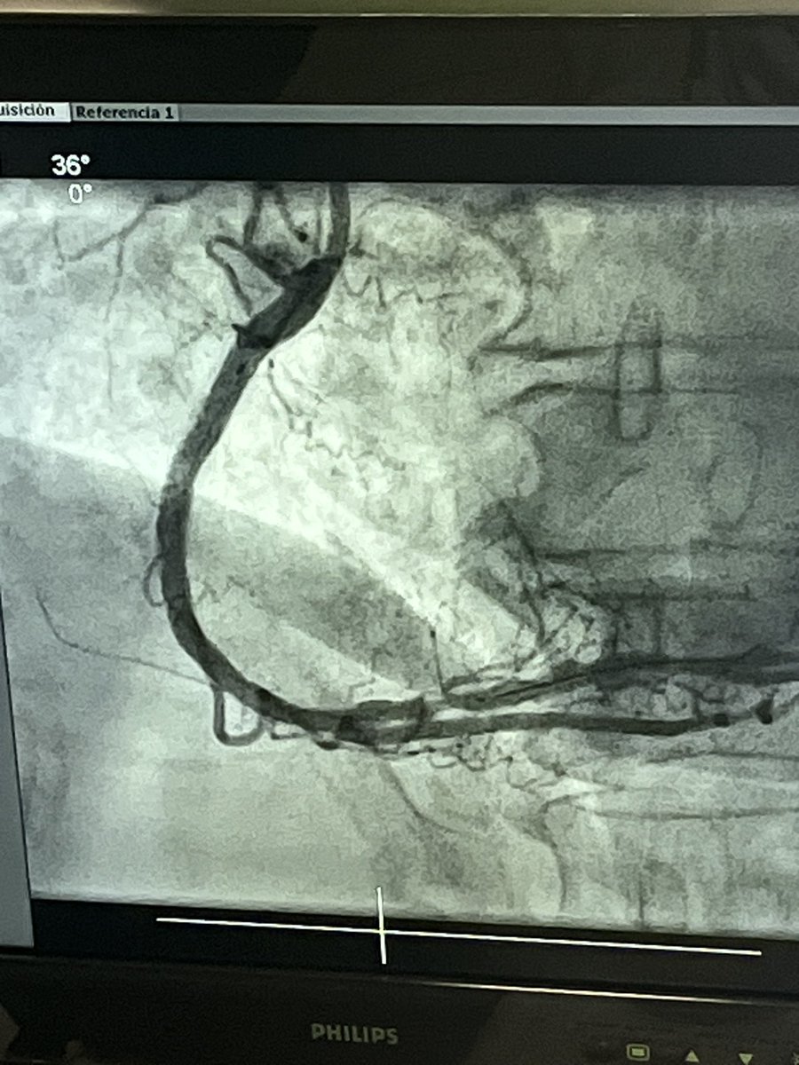 Sergio Carrasco Castillo (@sergecarr1) on Twitter photo Fantastic case in Tactical course, guided by Avvigo II system essential in challenging scenarios with final stenting Synergy XD 48 mm brilliant deliverability . Great manage by @helenatmCARDIO <a href="/hcuberogallego/">Héctor Cubero Gallego</a> <a href="/beavaquerizo/">Beatriz</a> <a href="/josepgomezlara/">josep</a> <a href="/rutalvar3z/">Rut Álvarez Velasco</a> Fantastic case in Tactical course, guided by Avvigo II system essential in challenging scenarios with final stenting Synergy XD 48 mm brilliant deliverability . Great manage by @helenatmCARDIO <a href="/hcuberogallego/">Héctor Cubero Gallego</a> <a href="/beavaquerizo/">Beatriz</a> <a href="/josepgomezlara/">josep</a> <a href="/rutalvar3z/">Rut Álvarez Velasco</a>